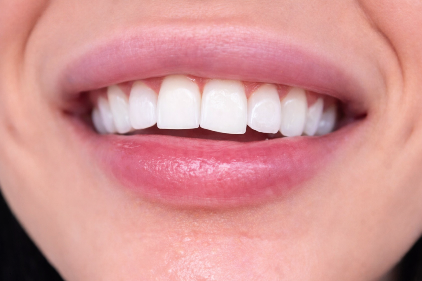 Purple Whitening Strips
